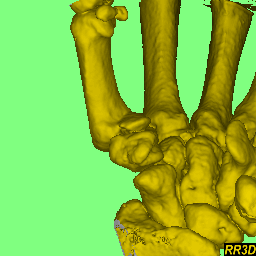 animation of thumb fracture